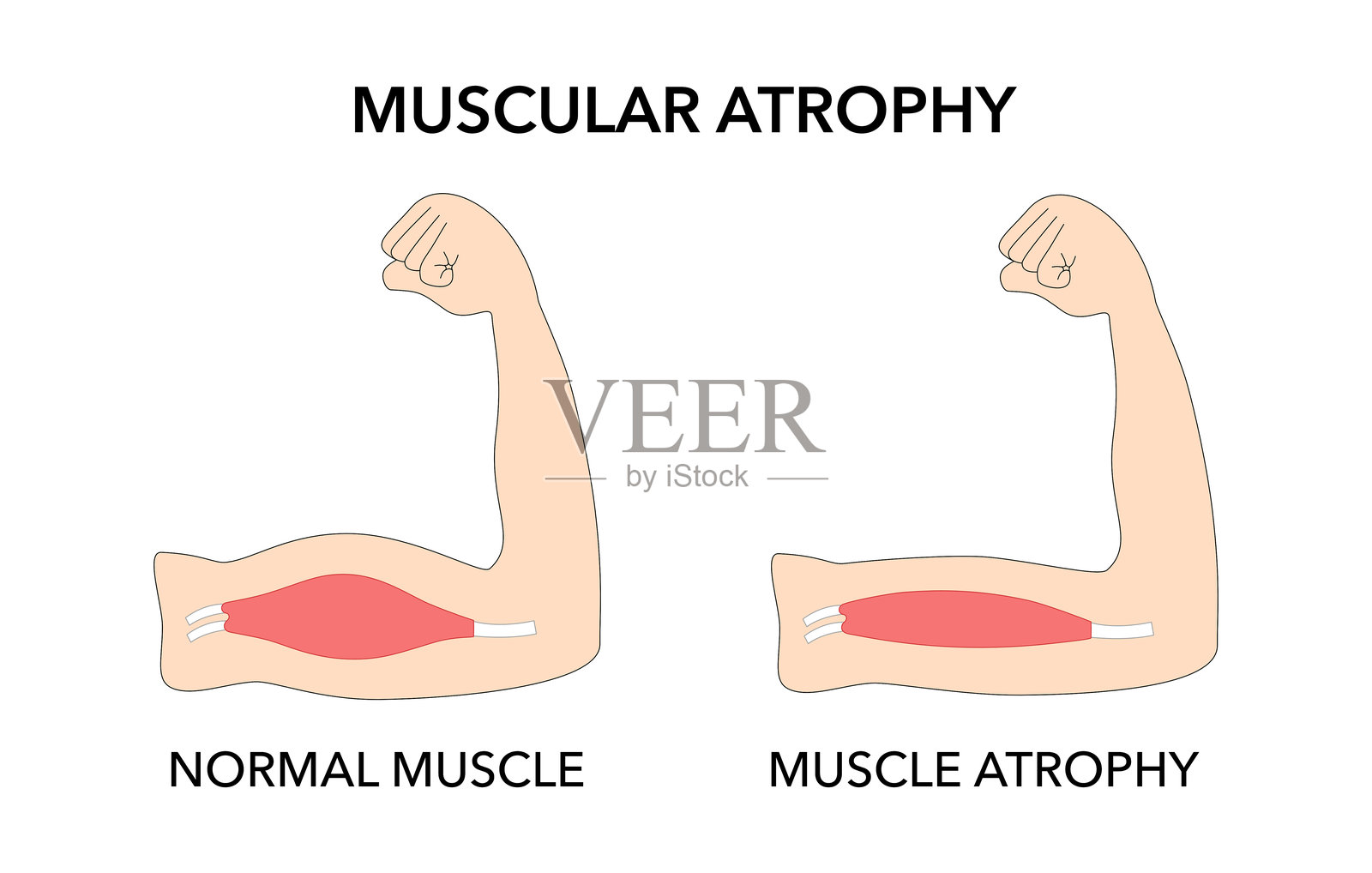 肌肉萎缩与健康轮廓对比图。虚弱的异常肌肉与正常运动障碍的矢量插图。插画图片素材