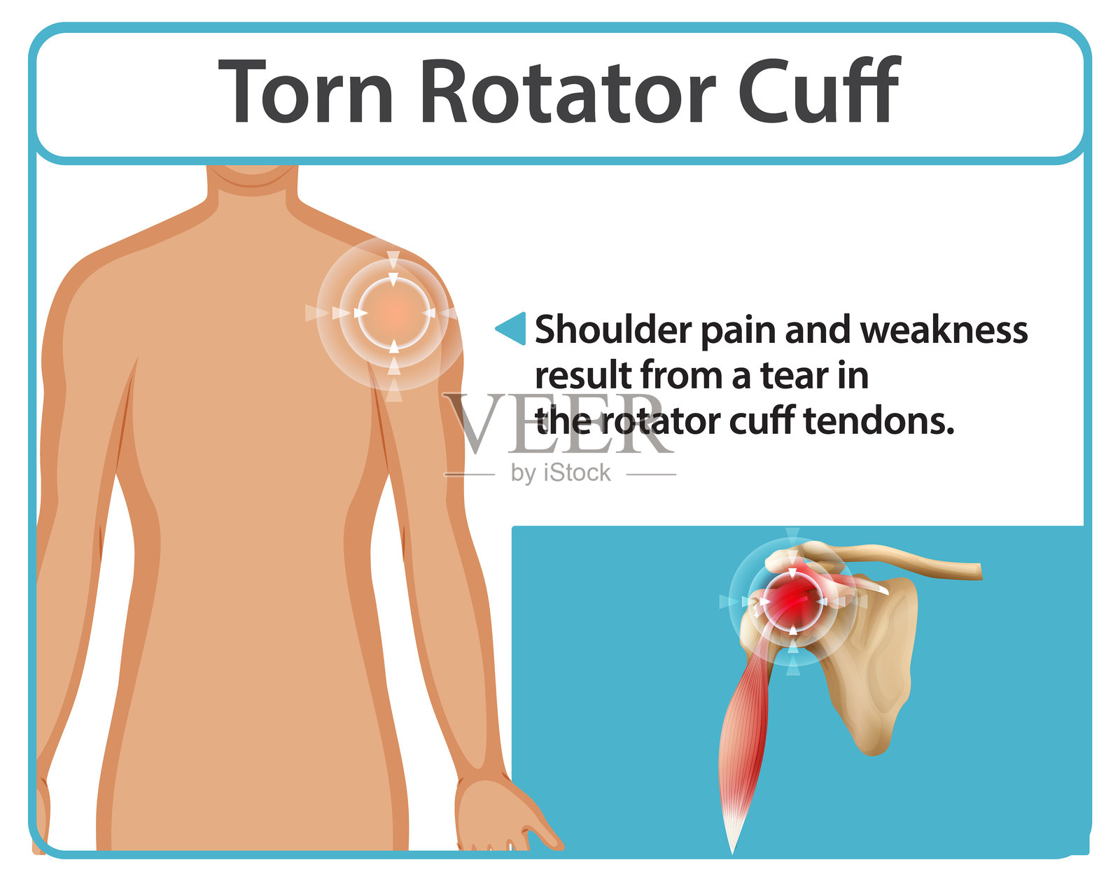 肩部疼痛和肌腱撕裂的插图插画图片素材