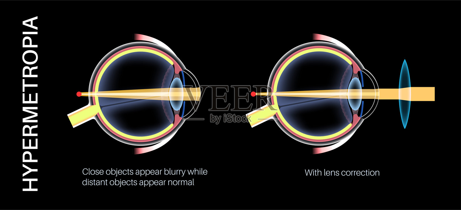 远视镜片矫正插画图片素材