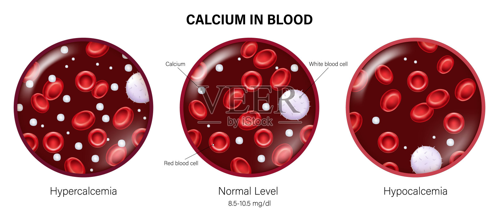 高钙血症、正常水平和低钙血症。血液中的钙矢量。比较血钙水平。插画图片素材