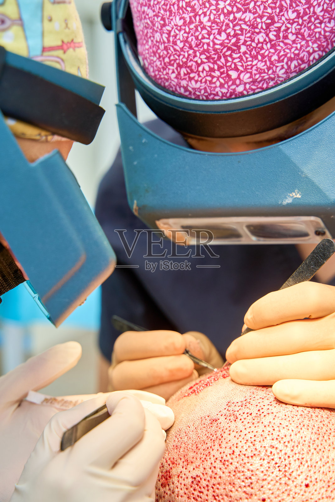 外科医生进行毛发移植手术特写照片摄影图片