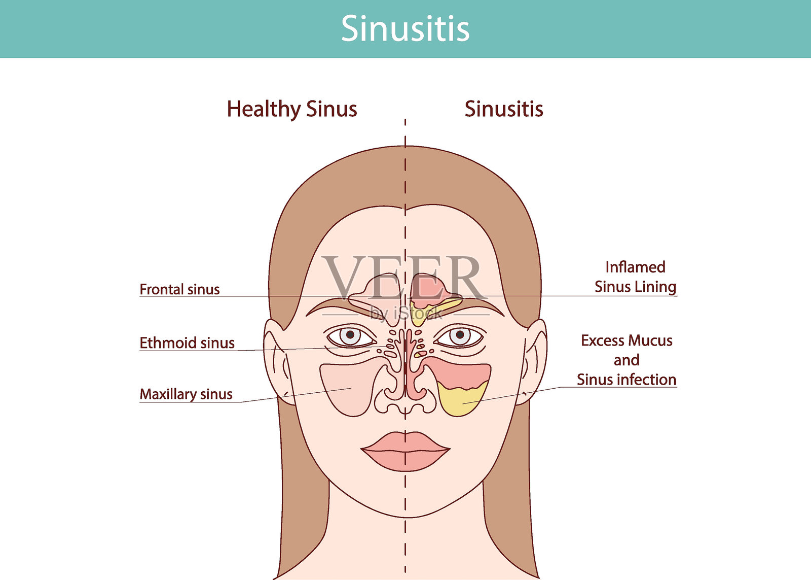 鼻窦炎的平面图像，包括感染、炎症和鼻部疾病。插画图片素材
