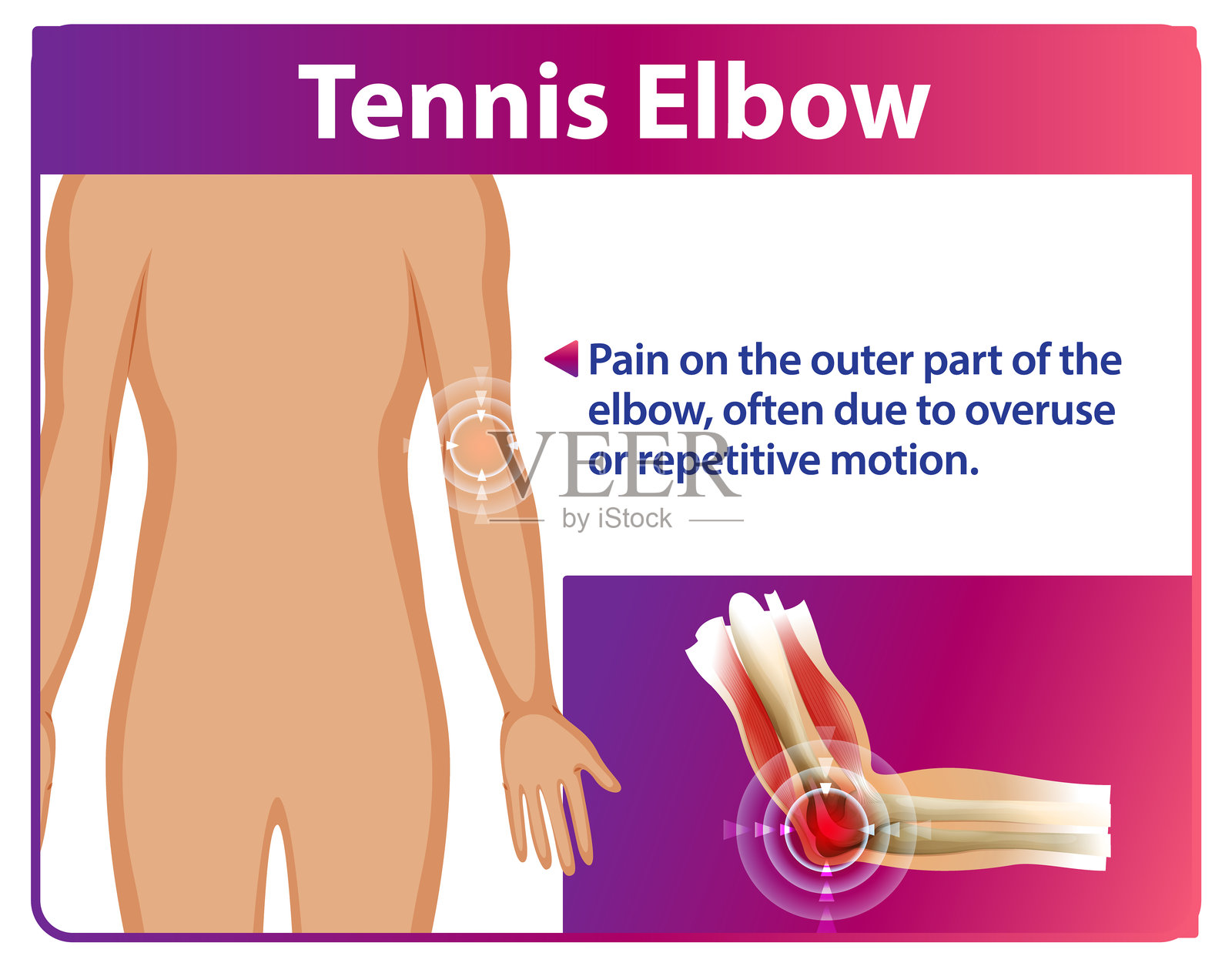 网球肘疼痛及解剖插图插画图片素材