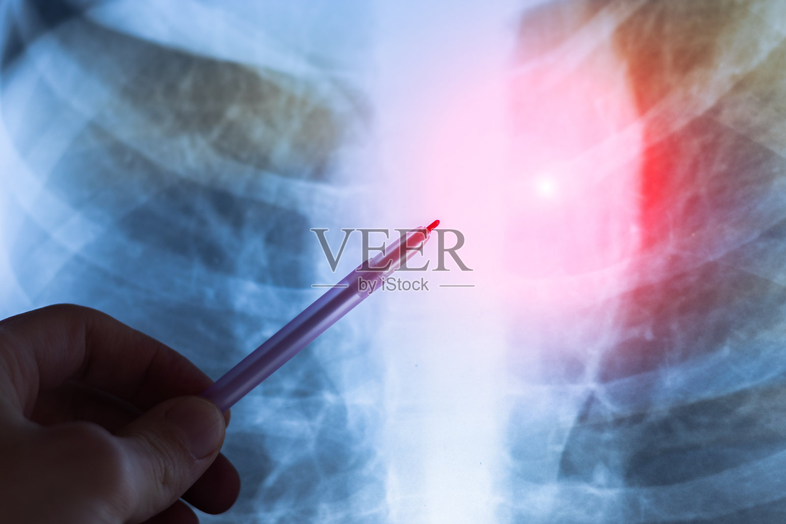 荧光摄影，X光。人类肺癌。医疗治疗概念。照片摄影图片