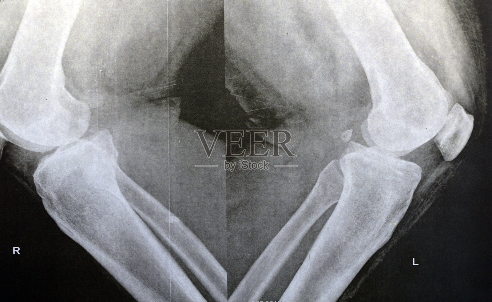 膝关节的普通X光片显示根据Kellgren和Lawrence骨关节炎分类系统明显的关节骨关节炎。照片摄影图片
