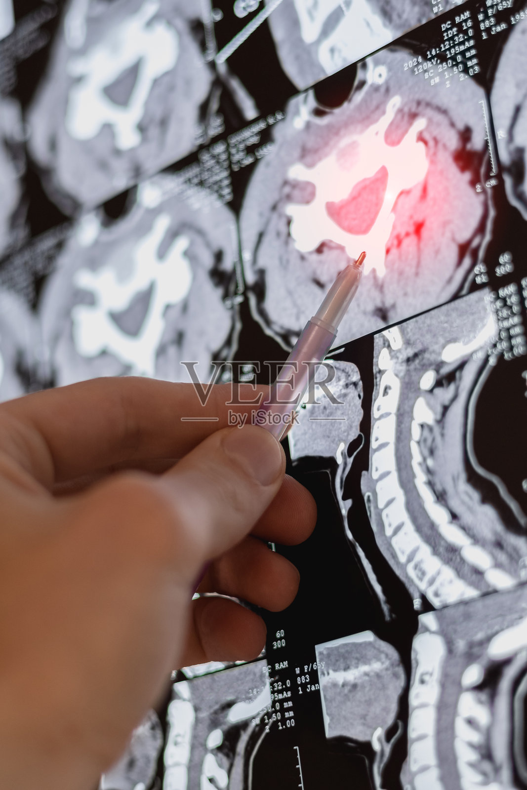 医生正在研究脊柱曲度的MRI或X光片的特写垂直图像。照片摄影图片