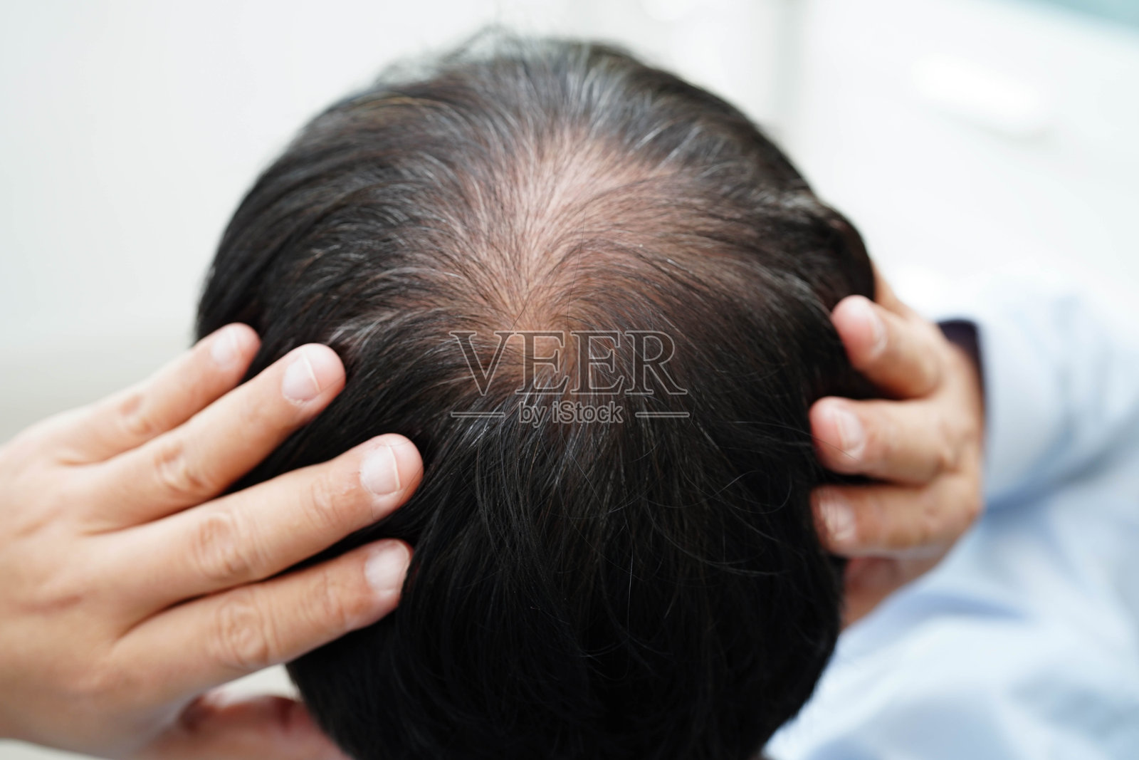 男性秃头，脱发治疗健康问题。照片摄影图片