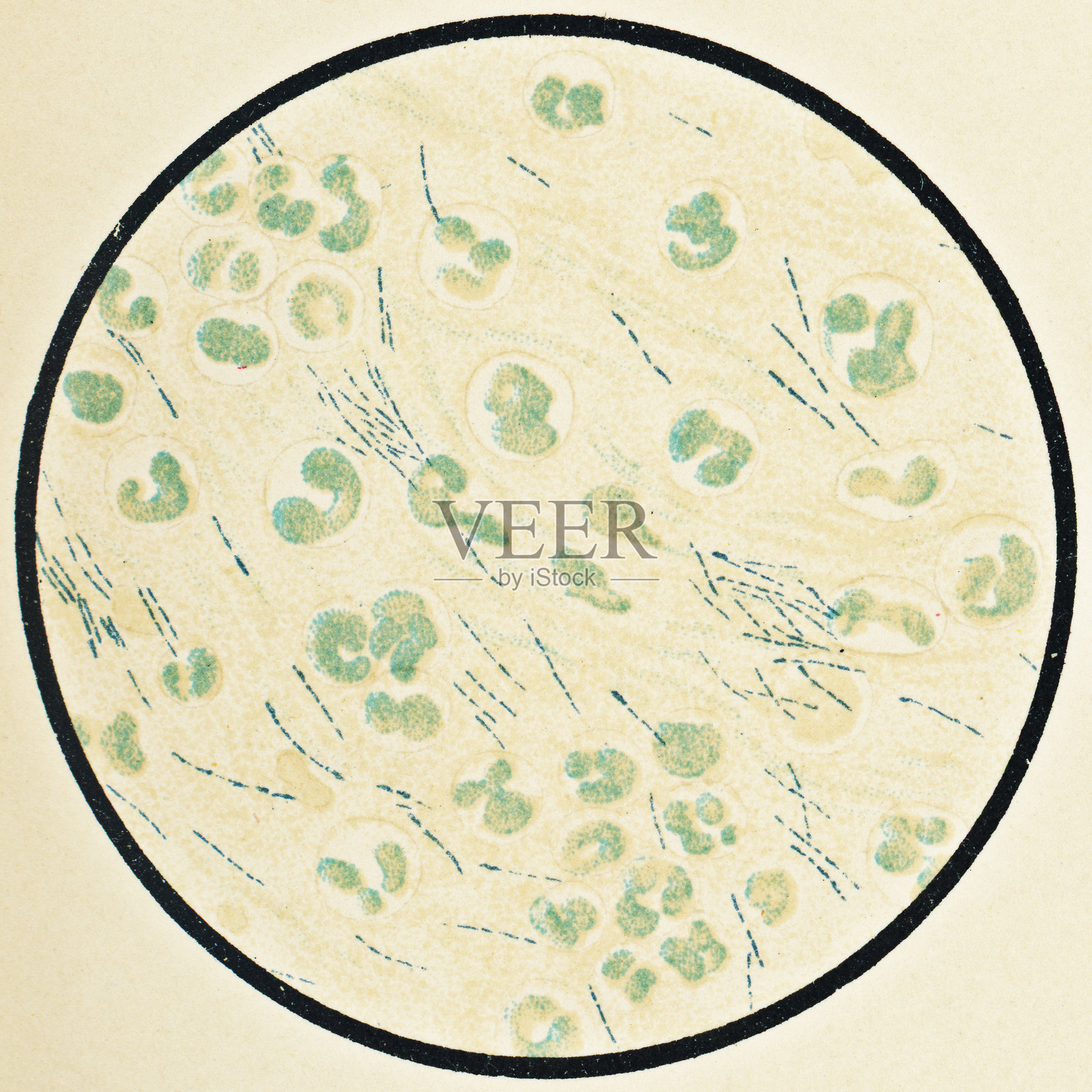 19世纪患者的人体血细胞和马利伯克霍尔德氏菌的显微镜观察插画图片素材