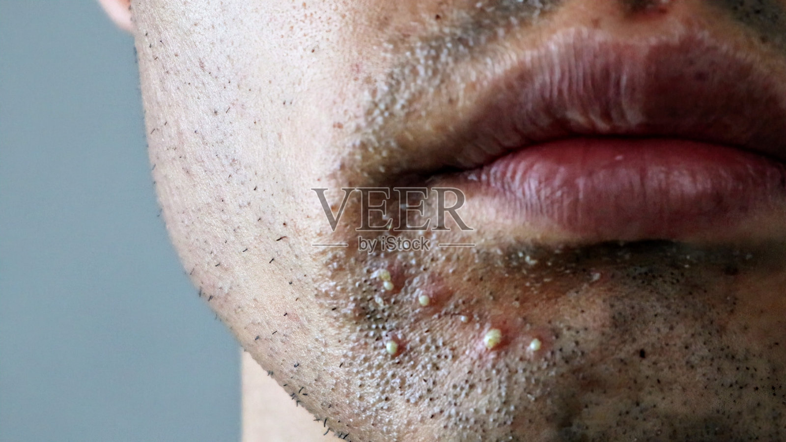 一名男子的嘴部在激光脱毛后皮肤粗糙照片摄影图片