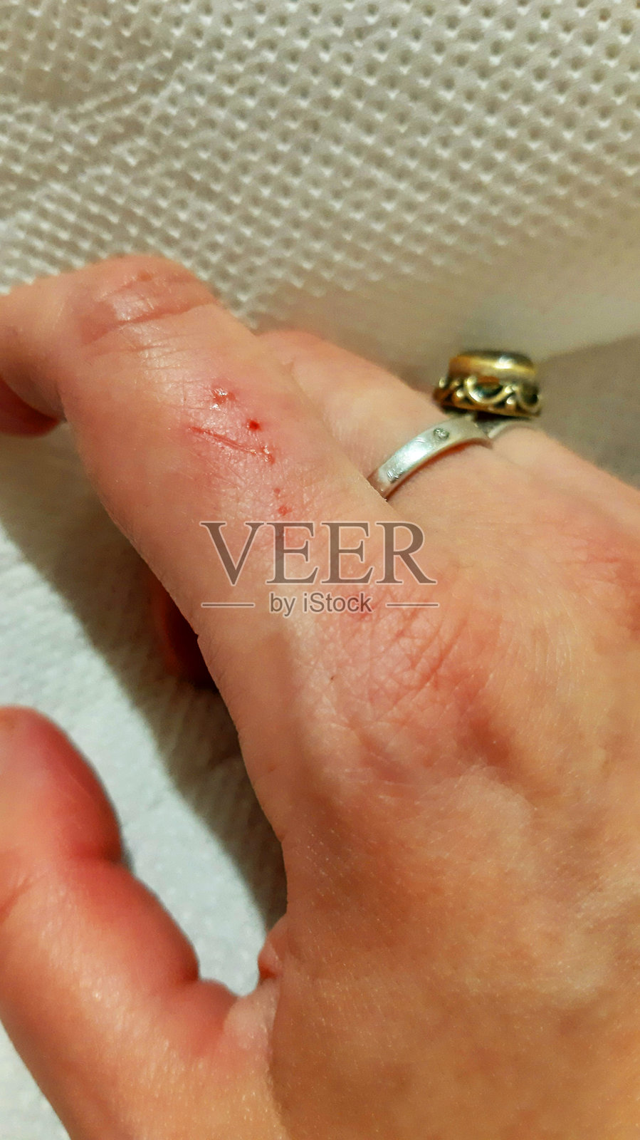 皮肤病，炎症过程，血液。手术，创伤，出血的伤口。疼痛，痛苦，医院。照片颜色照片摄影图片