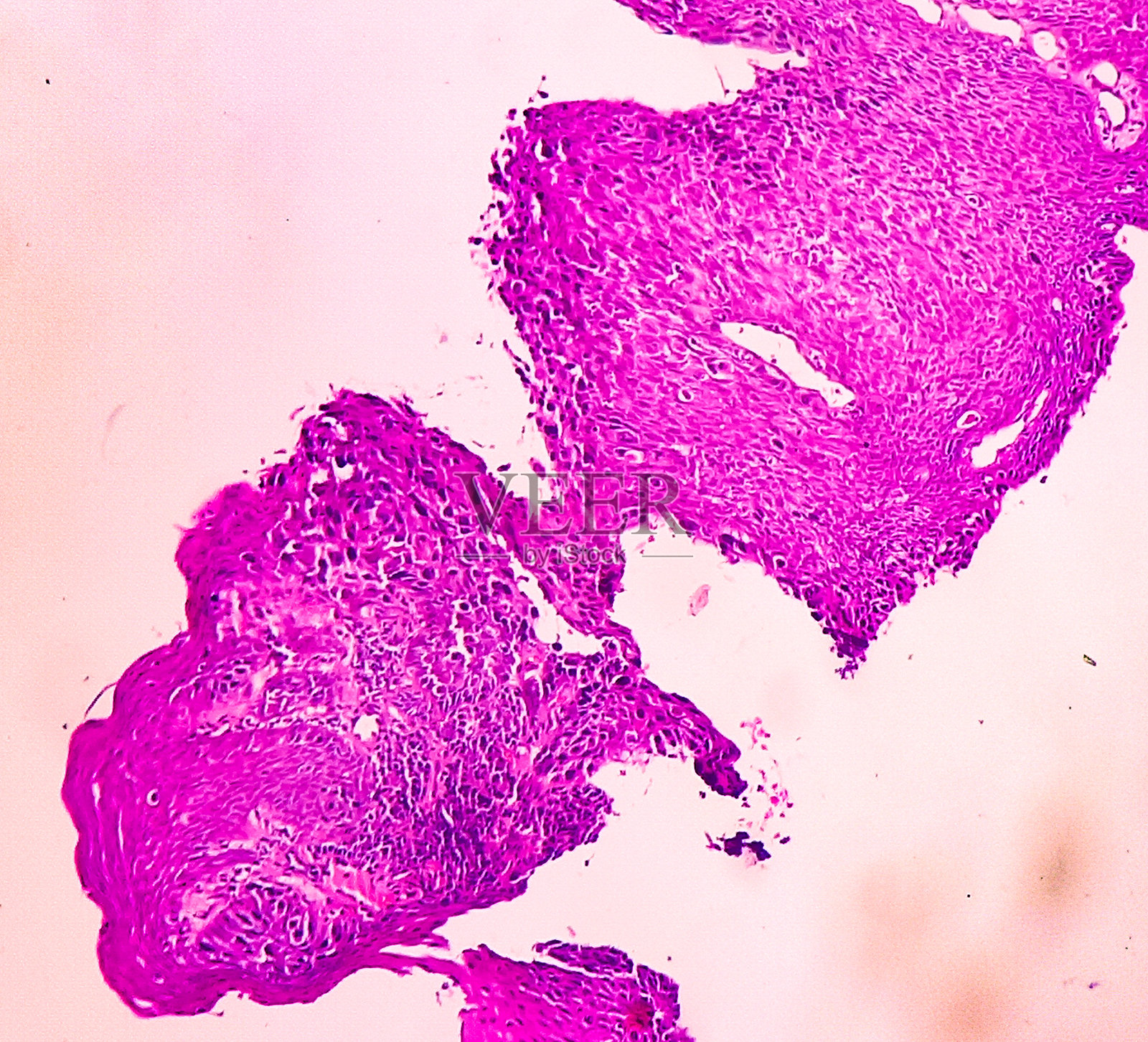 食管黏膜的部分显示出鳞状细胞癌。照片摄影图片