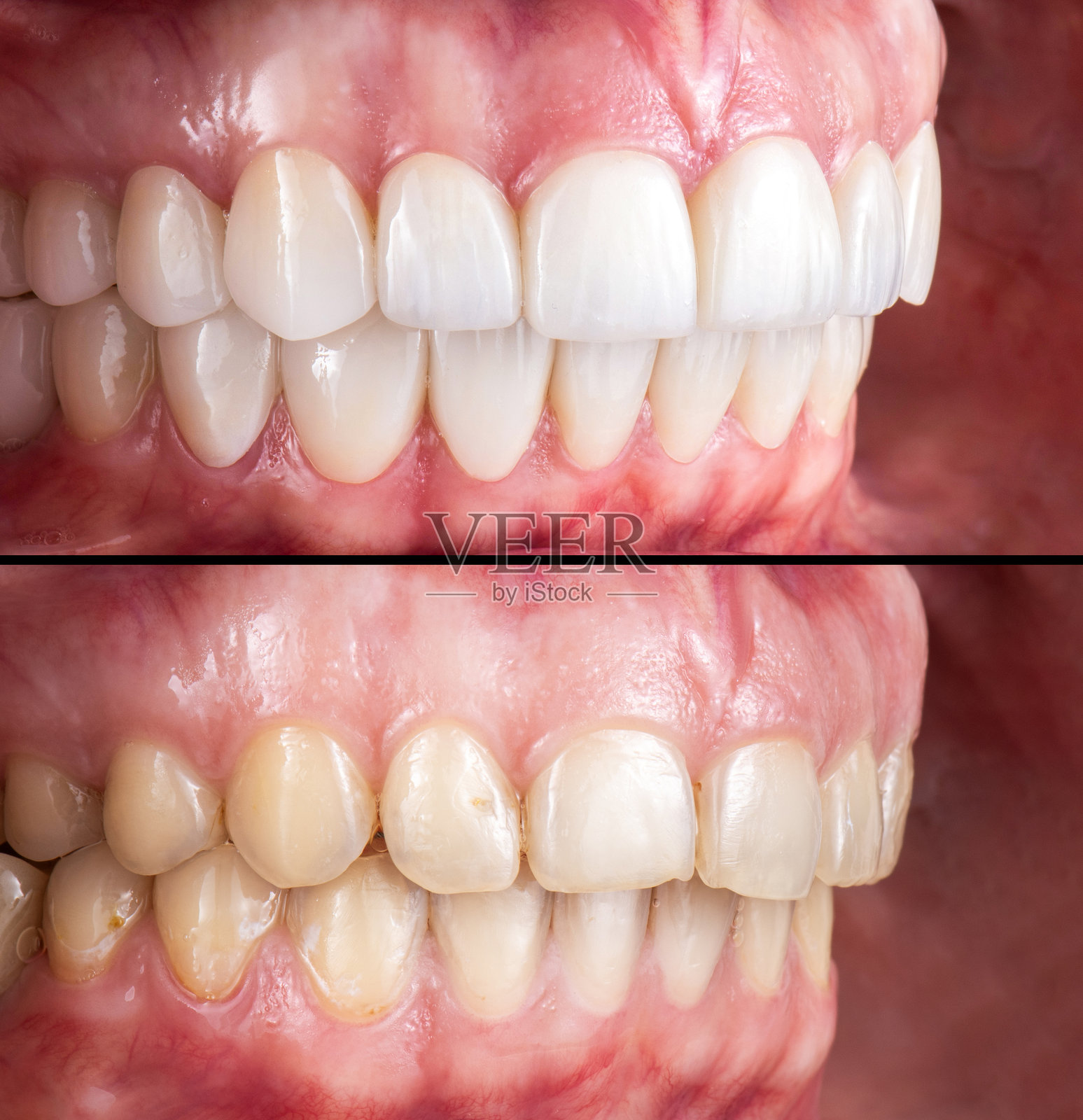 陶瓷牙冠和贴面前后的对比照片照片摄影图片