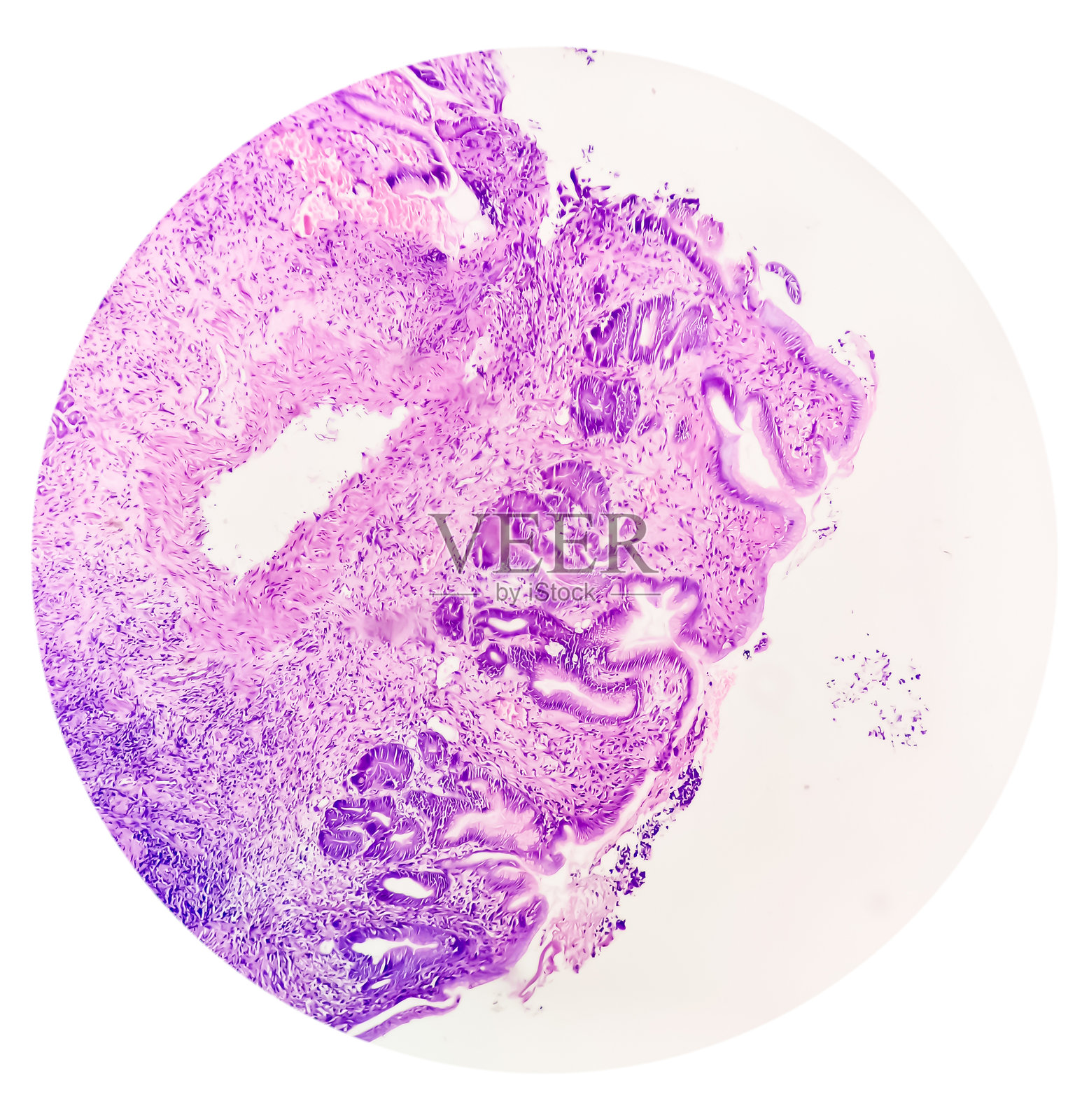 胃活检的显微照片，显示三级腺癌照片摄影图片