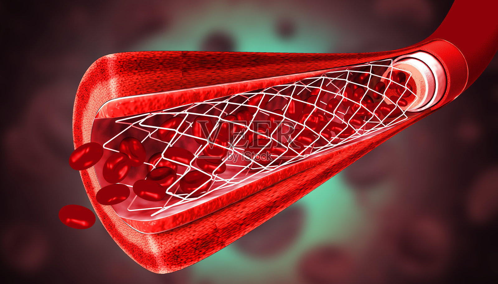 胆固醇堵塞的动脉。血管中胆固醇的积累。支架成形术。3D插图照片摄影图片