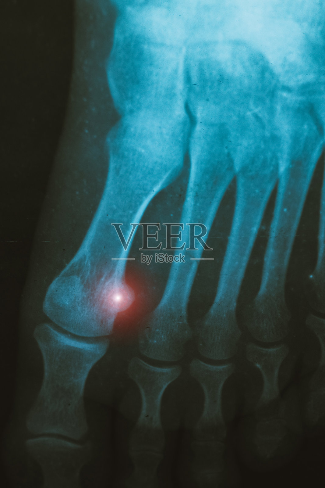 肿瘤跖骨的垂直X光扫描。照片摄影图片