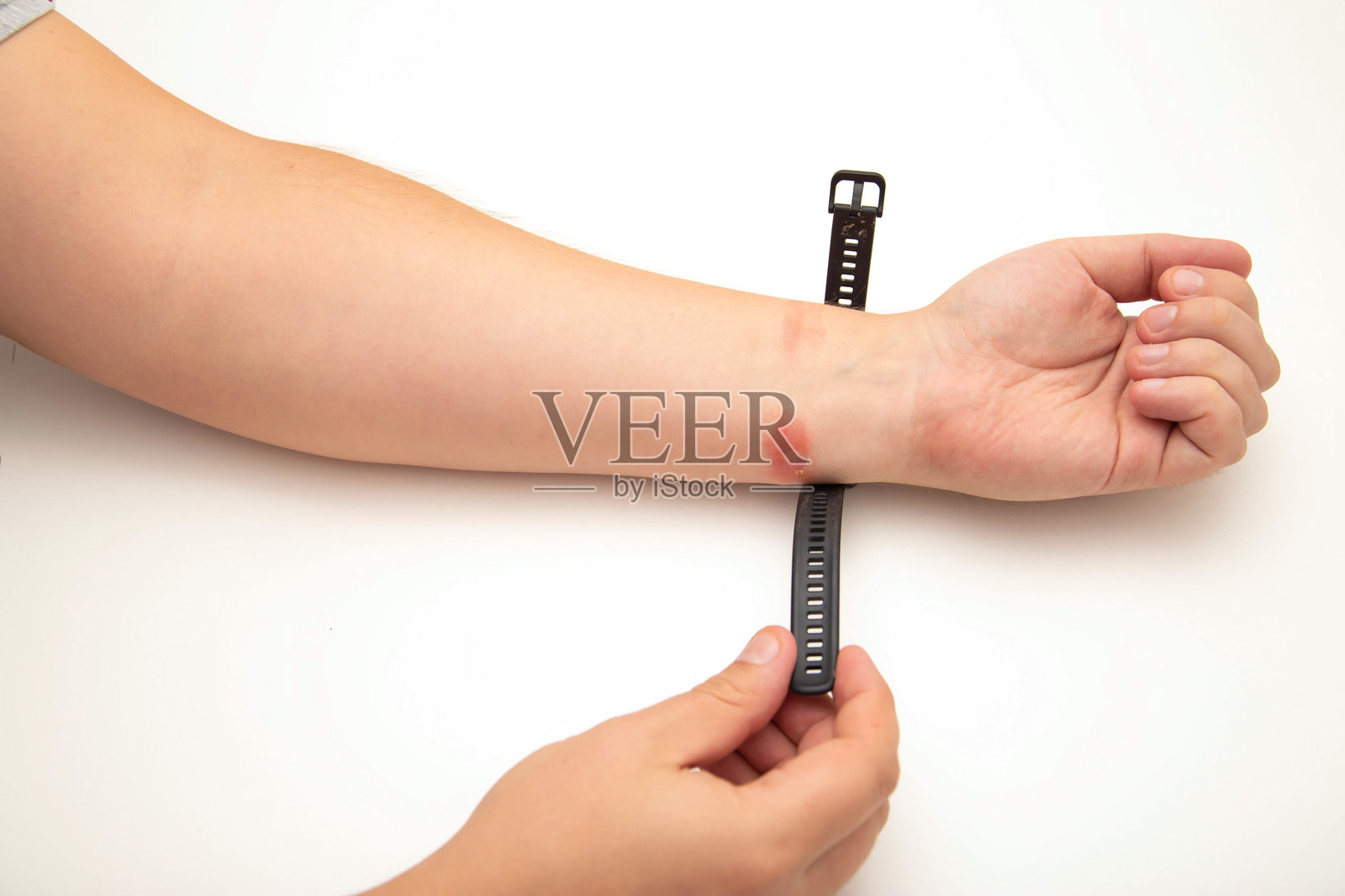 佩戴手表或健身手环后皮肤出现刺激、发红和瘙痒。表带过敏，接触性皮炎，特写照片摄影图片