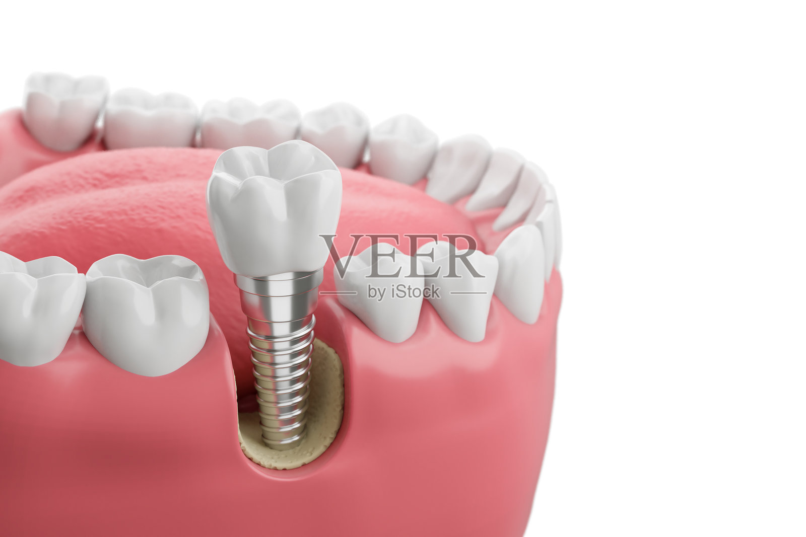 特写白色牙齿和牙龈与牙科植入物，人类牙齿医学概念，3d插图。照片摄影图片