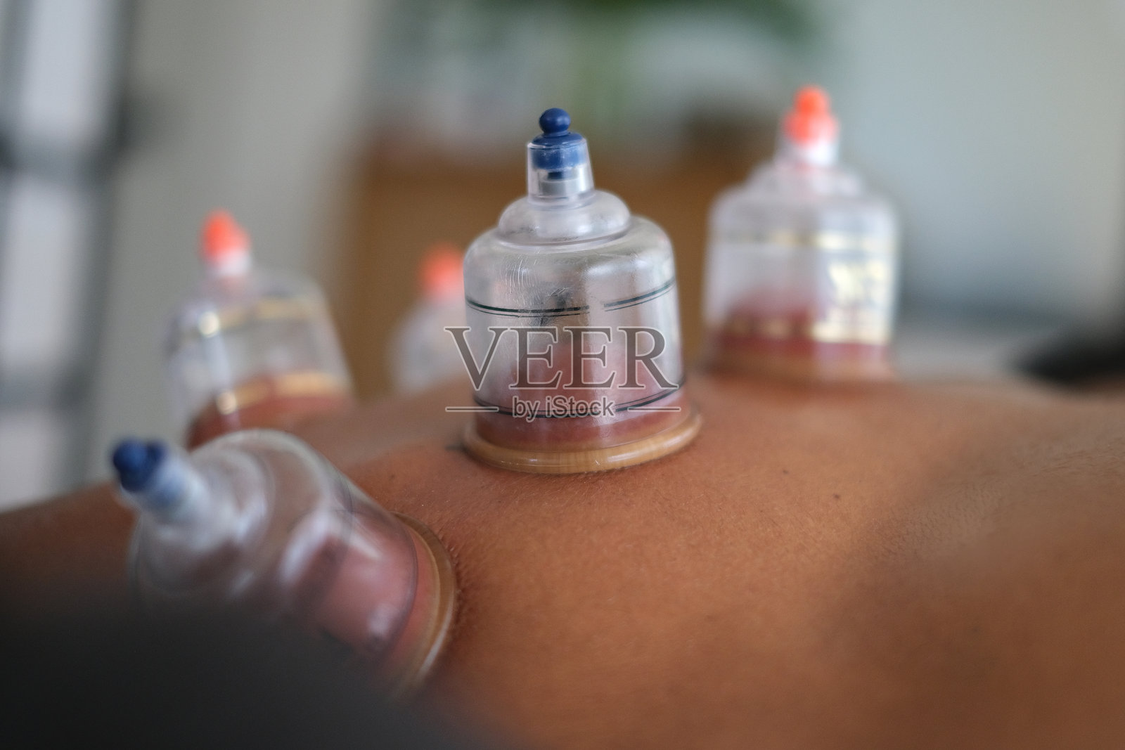 拔罐疗法照片摄影图片