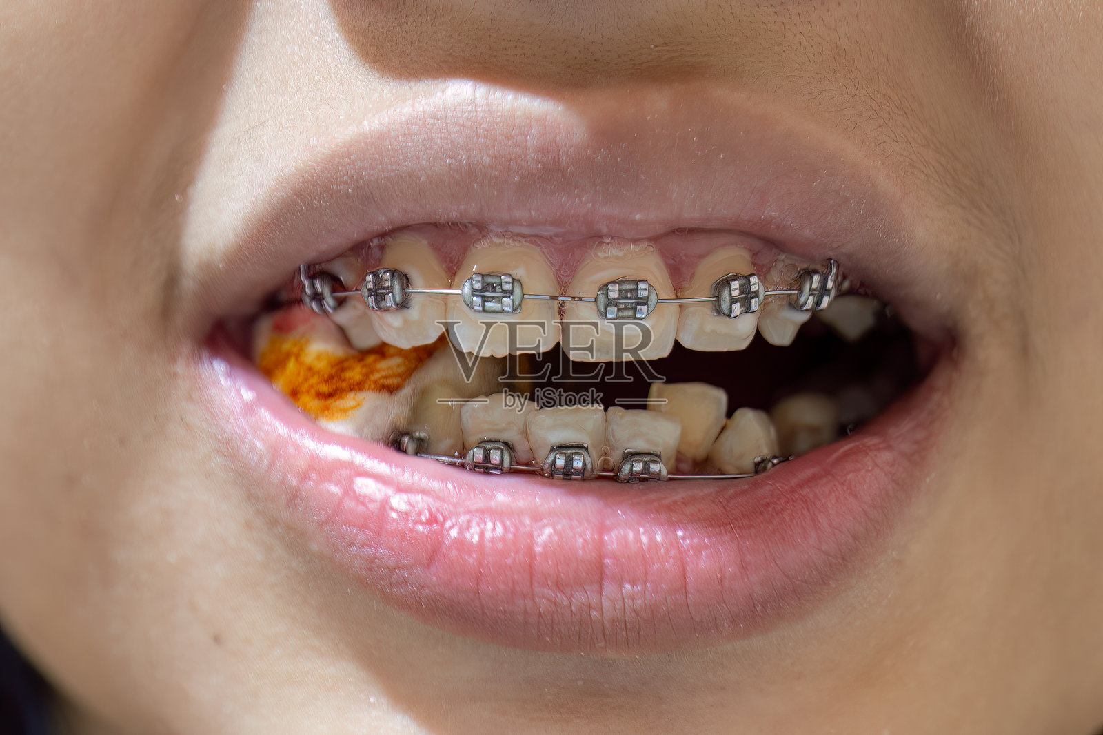 正在接受正畸治疗的患者。照片摄影图片