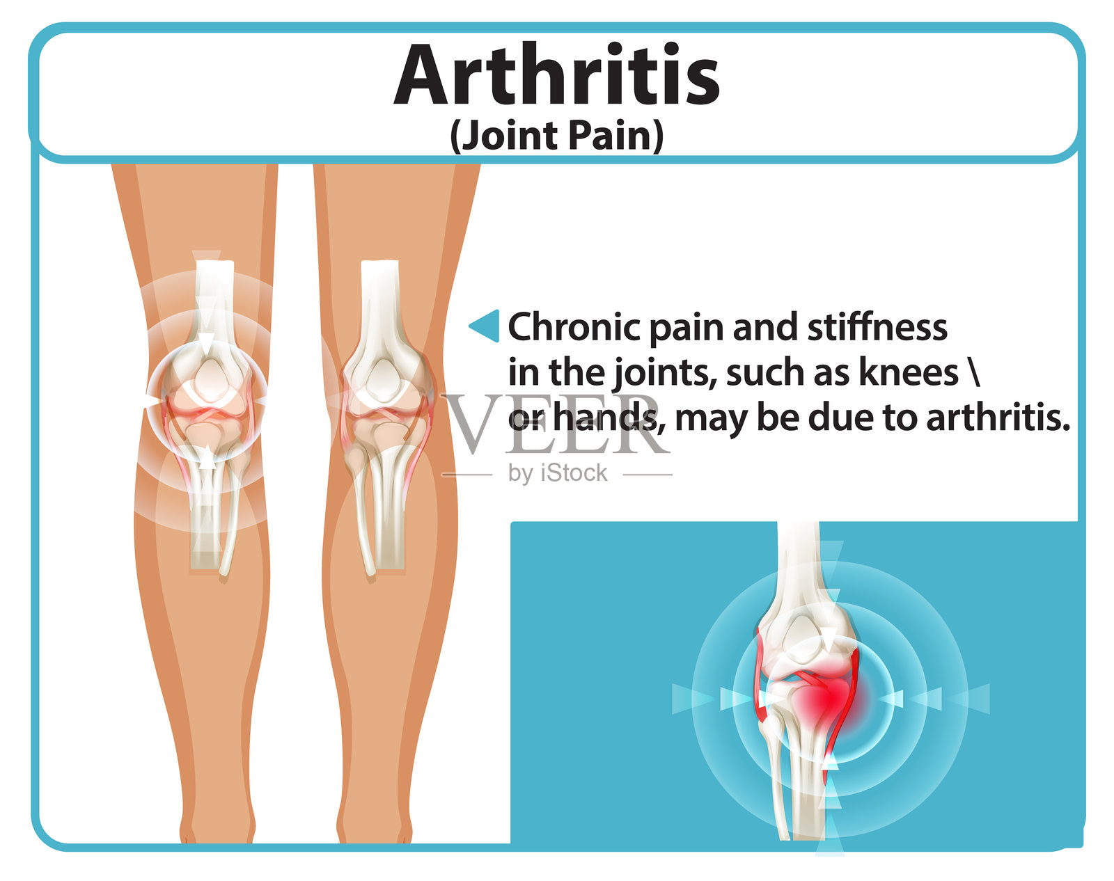关节炎影响膝关节的插图插画图片素材