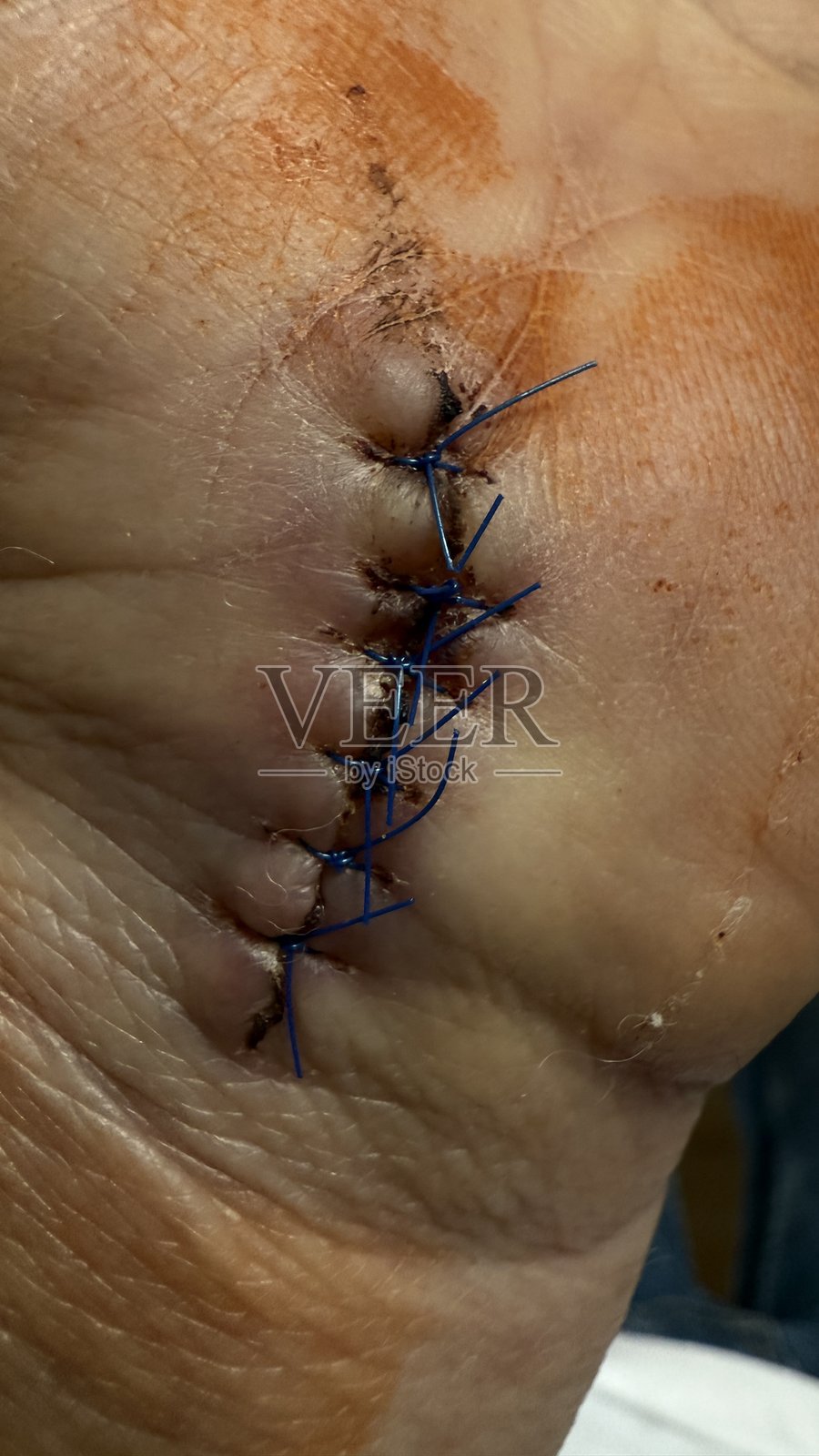 伤口缝合身体手术绷带照片摄影图片