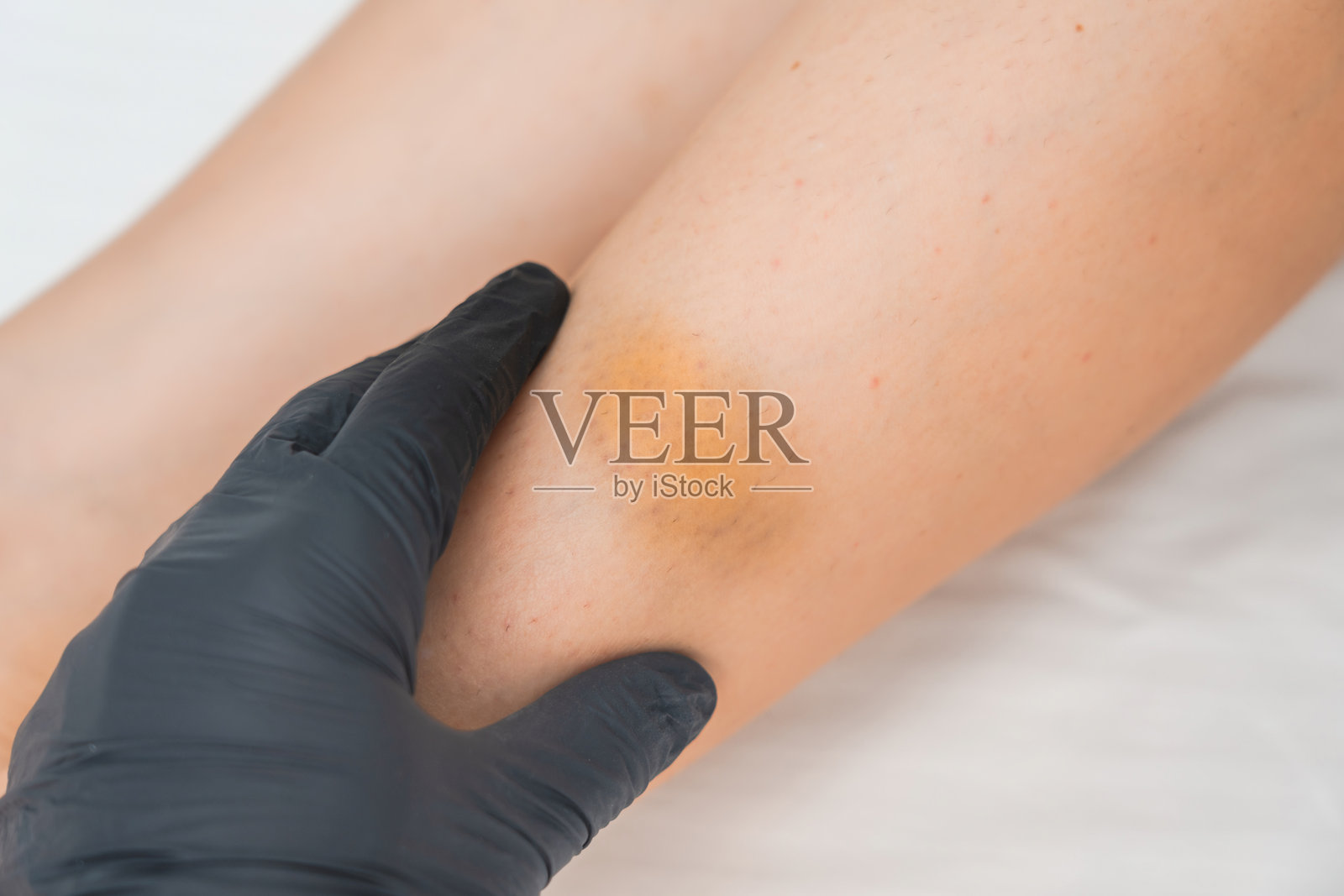 医生正在检查有淤伤和血肿的女性腿部。照片摄影图片