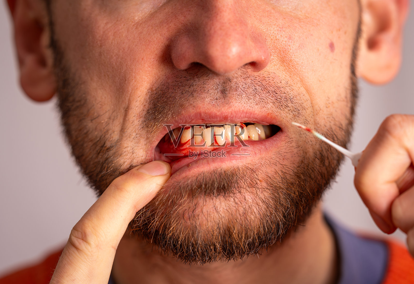 男子手持牙科橡胶牙签，展示出出血的牙龈，牙龈疾病由口腔卫生不良引起。照片摄影图片