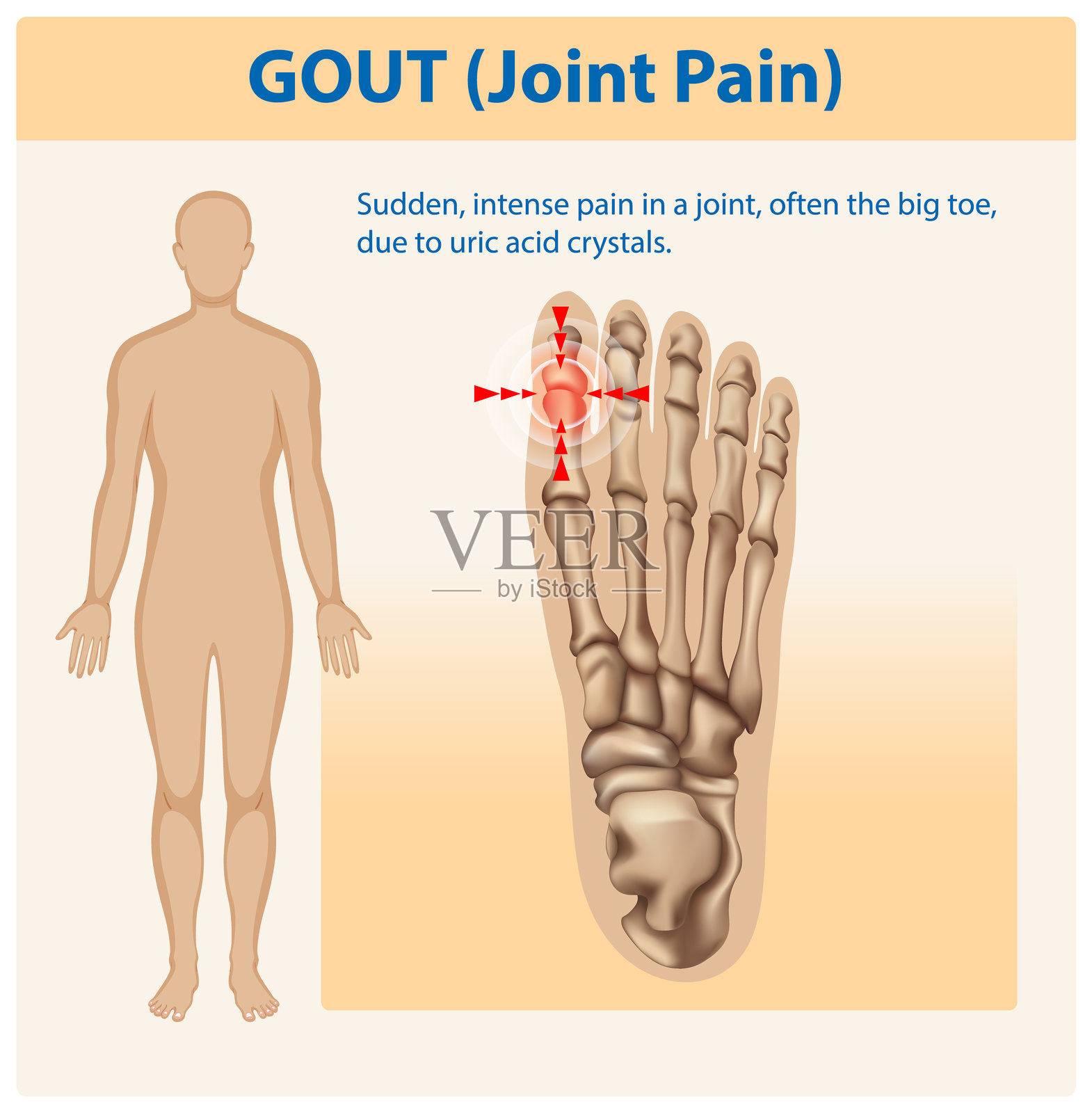 痛风影响大脚趾关节的插图插画图片素材