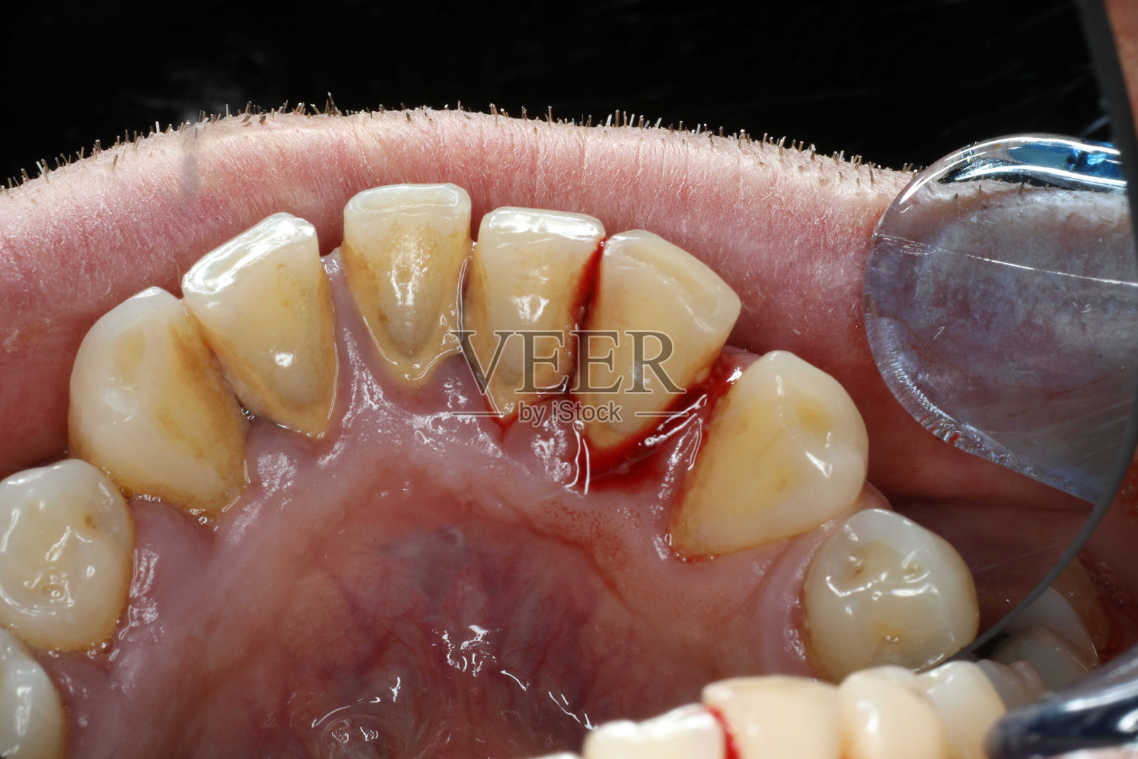 发炎出血的牙龈，疼痛的牙龈，牙龈感染，口腔概念，健康。照片摄影图片