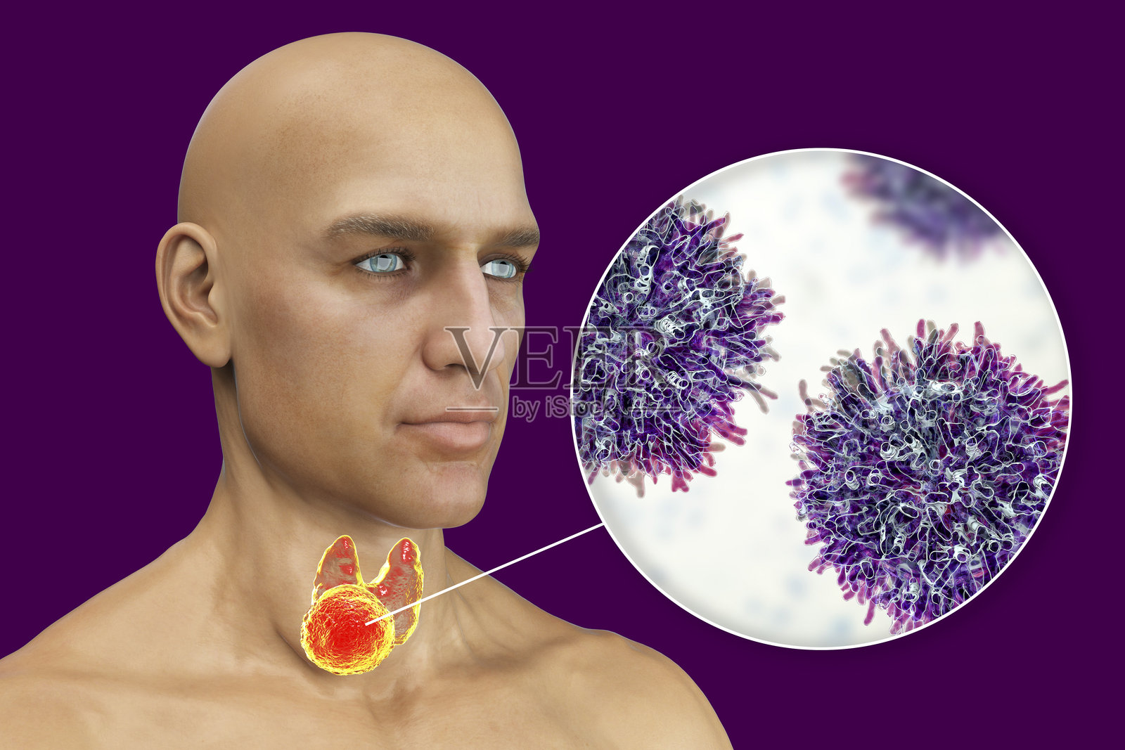 甲状腺癌，插图照片摄影图片
