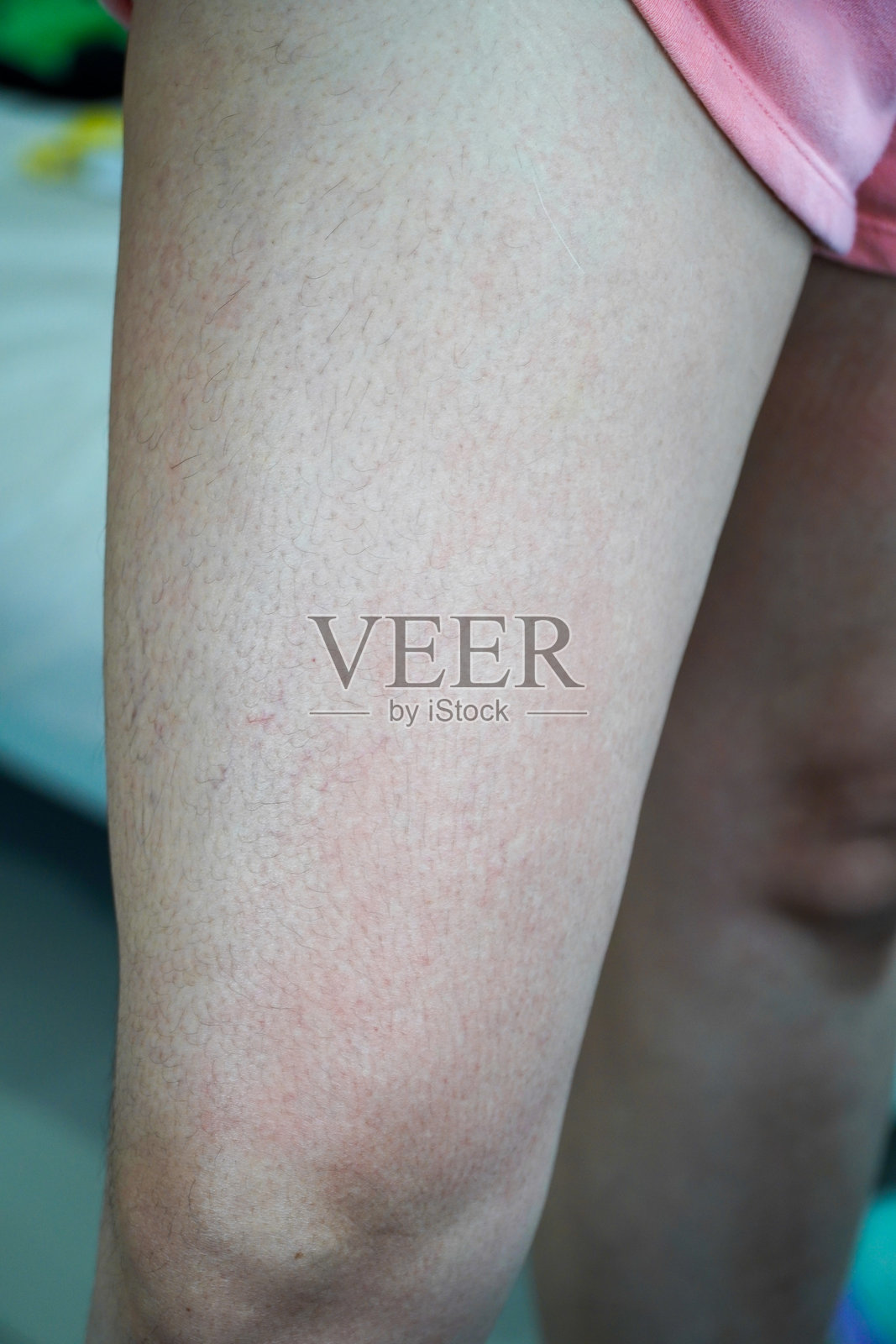 女性在大腿上抓挠湿疹。皮肤病治疗的概念照片摄影图片