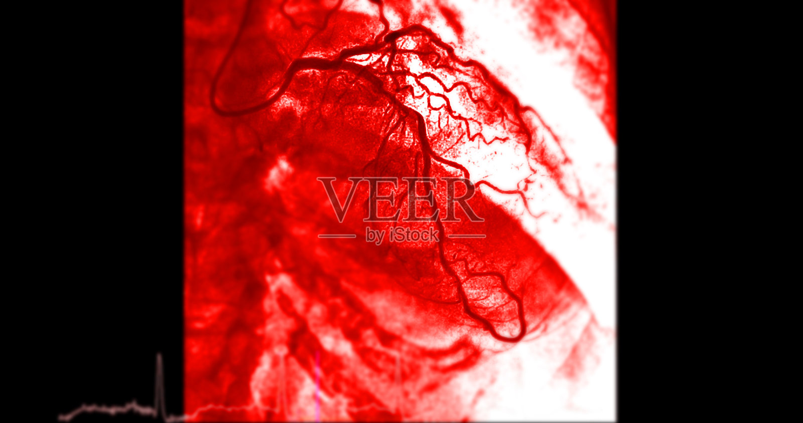 心脏导管插入术是一种用于检查心脏血管的医疗程序。照片摄影图片