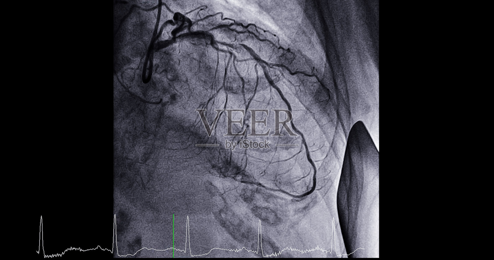 心脏导管插入术是一种用于检查心脏血管的医疗程序。照片摄影图片