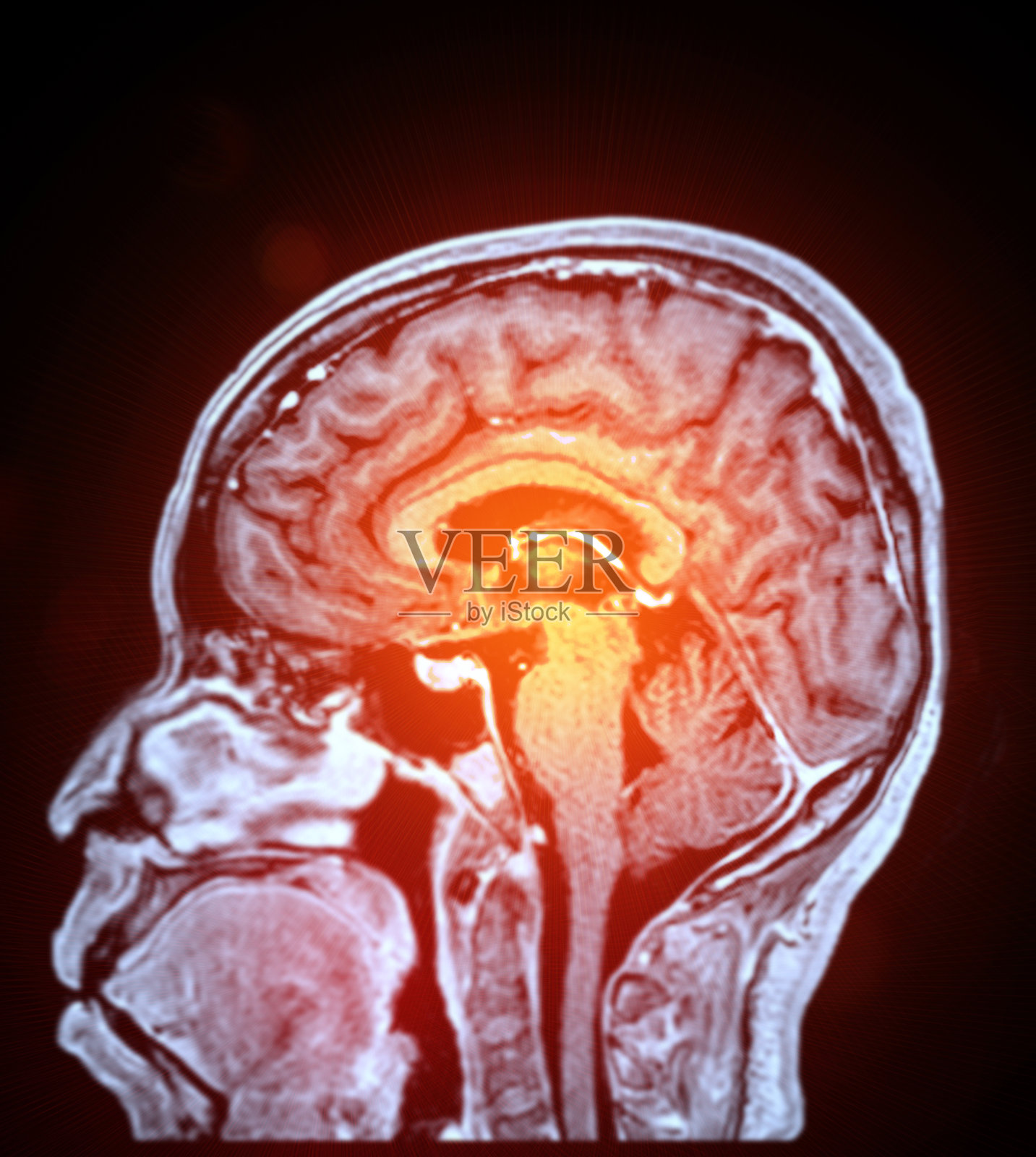 MRI脑灌注成像有助于评估脑血流和组织活力。照片摄影图片