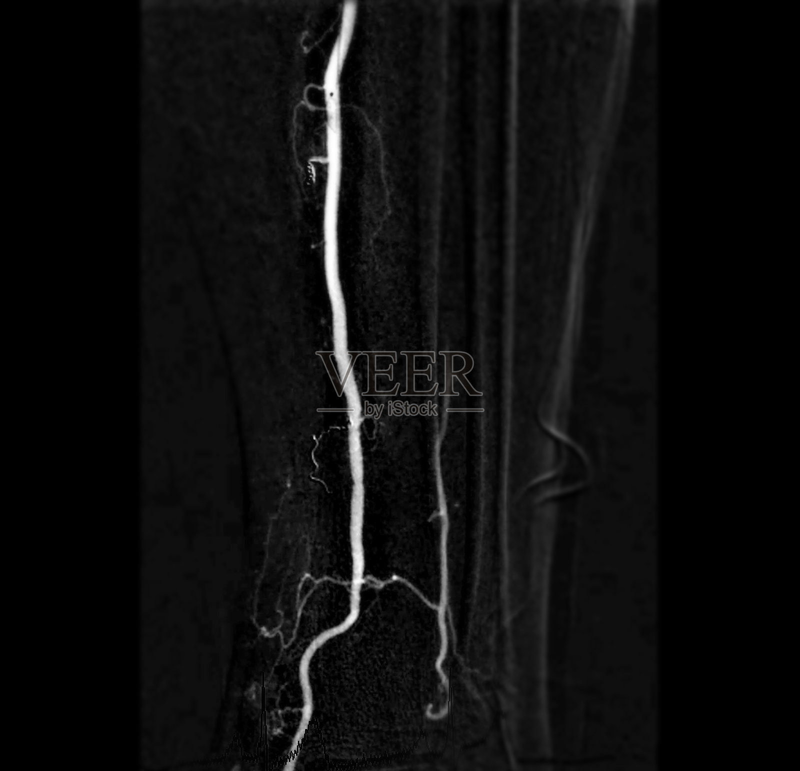 股动脉的股动脉造影，显示在白色背景上孤立的股动脉血管，用于诊断动脉粥样硬化。照片摄影图片