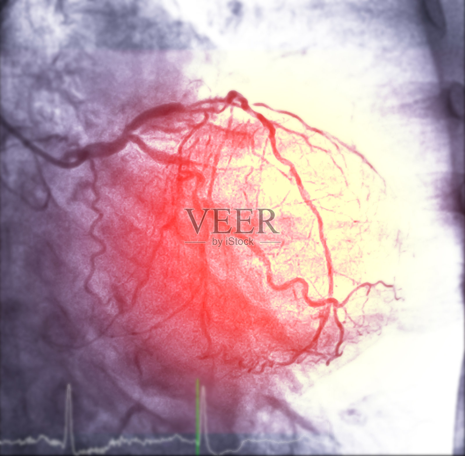 心脏导管插入术是一种用于检查心脏血管的医疗程序。照片摄影图片