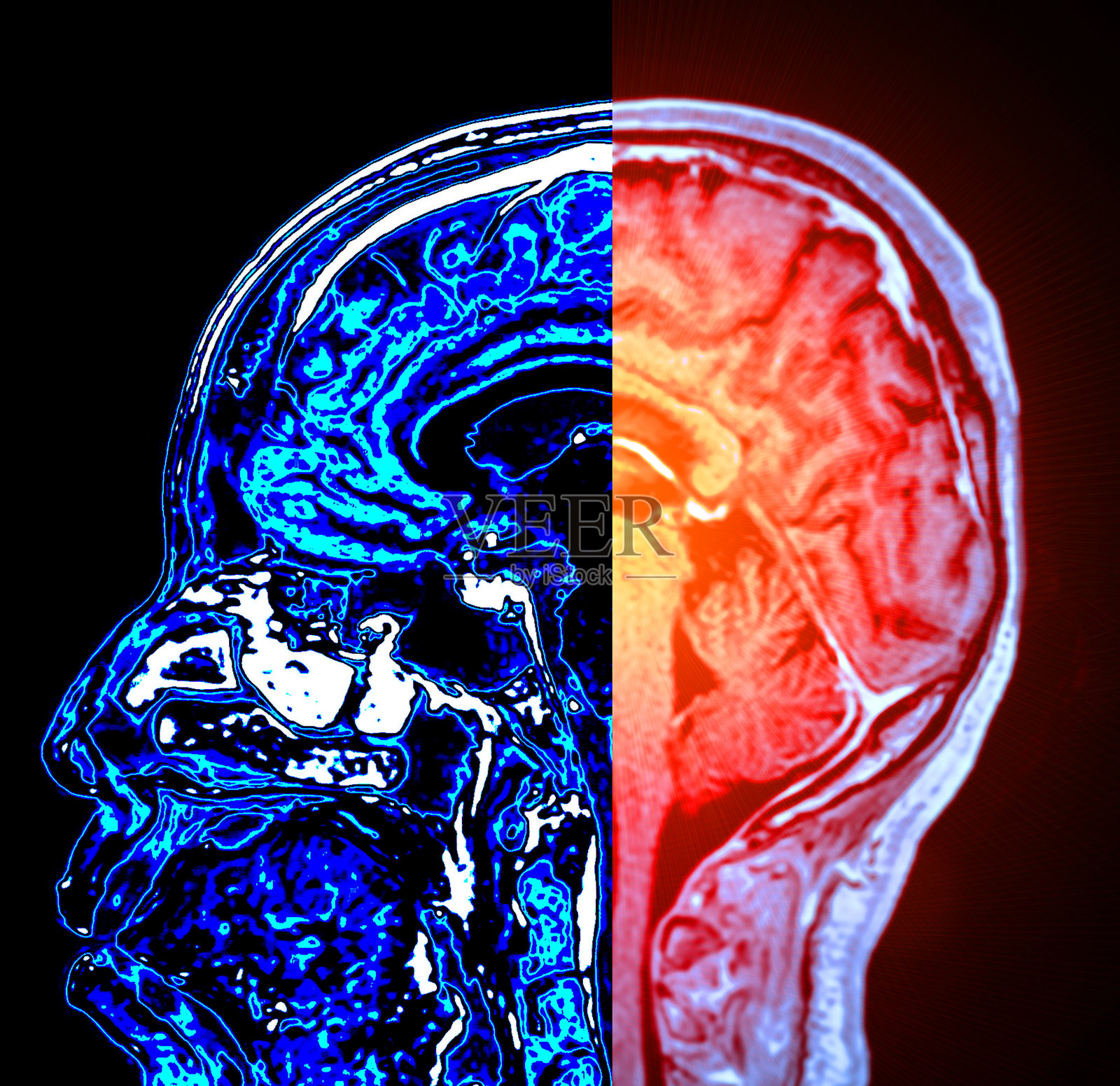 MRI脑灌注成像有助于评估脑血流和组织活力。照片摄影图片