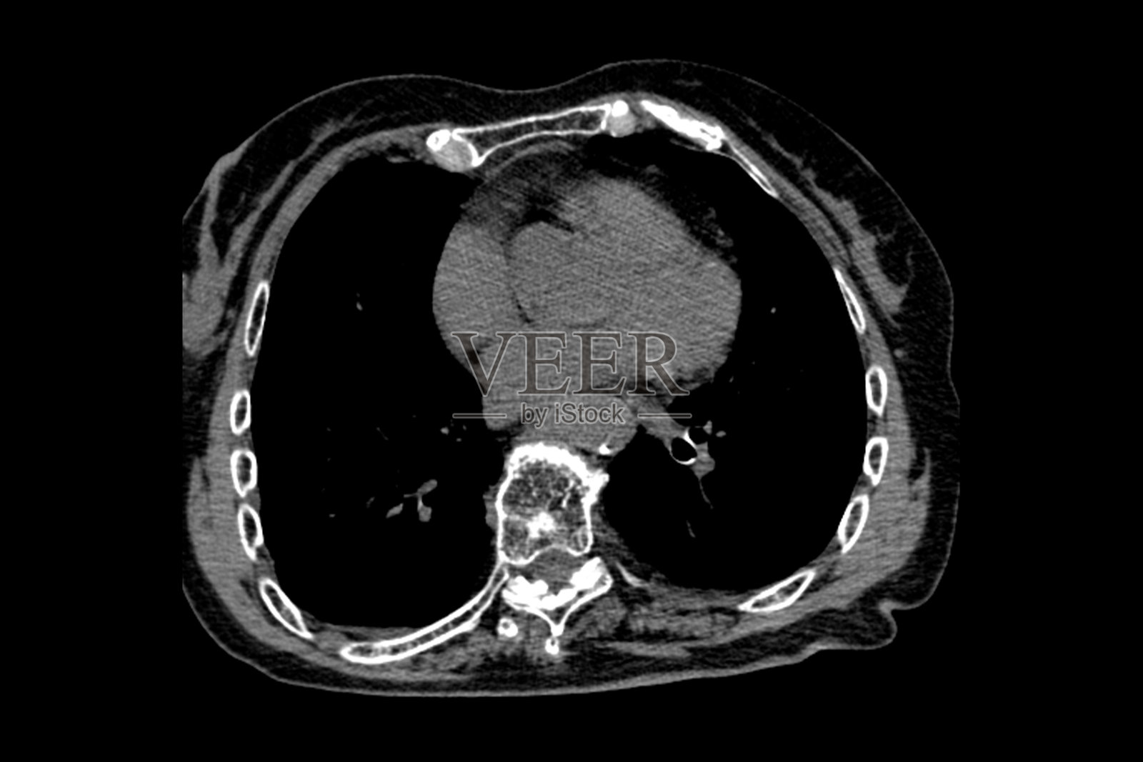 一位祖母在摔倒后进行的计算机断层扫描，显示出骨质疏松和Th9-Th12椎体的压缩性骨折，以及L1-L2椎体手术后的变形。照片摄影图片
