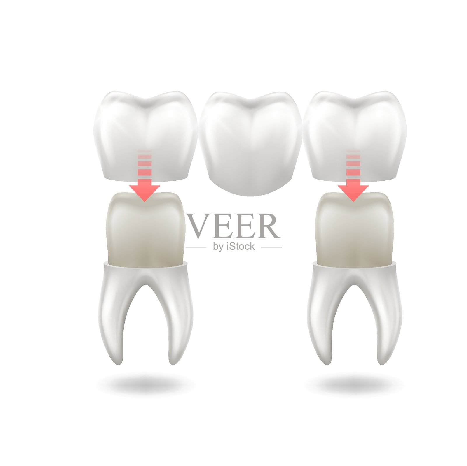 牙冠手术的插图插画图片素材