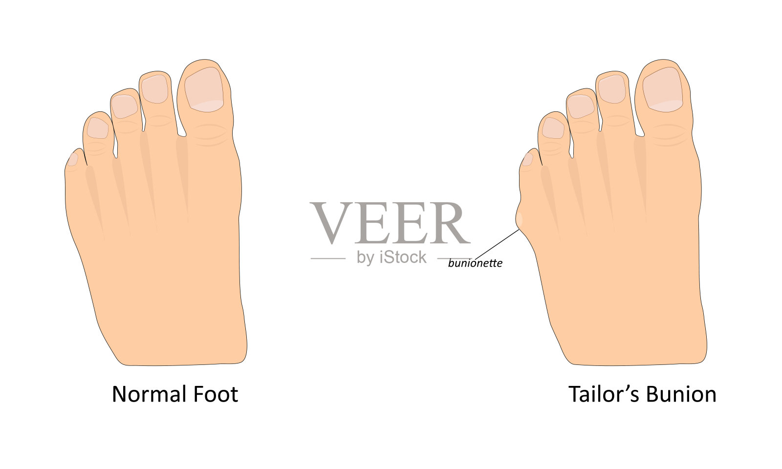 裁缝的拇外翻矢量插图插画图片素材