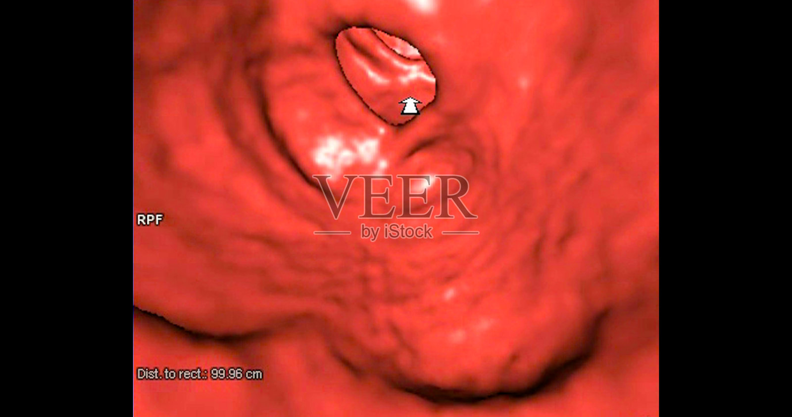CT结肠成像3D渲染图像用于诊断结肠癌和直肠癌。照片摄影图片