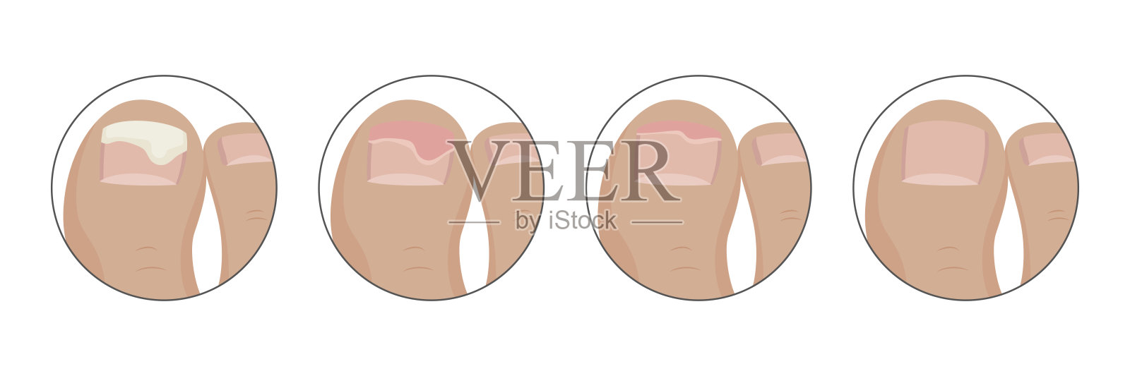 指甲因甲离解、真菌感染或创伤而恢复中插画图片素材