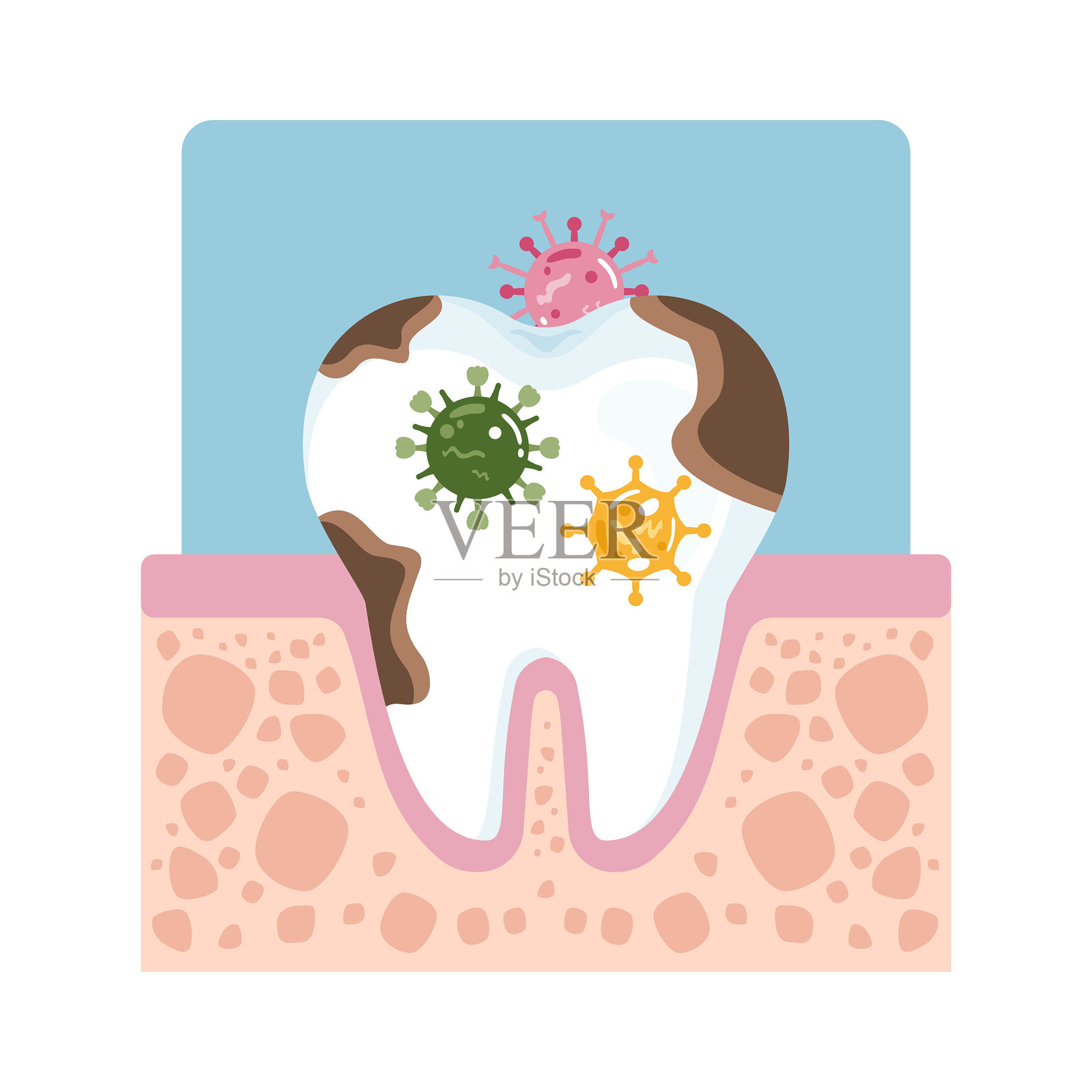 腐烂的牙齿上有细菌和病菌。牙科问题、感染和卫生不良的概念。矢量插图，背景为白色。插画图片素材