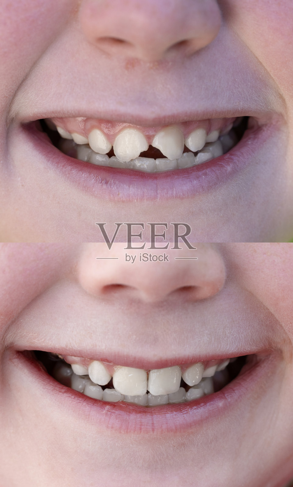 缺损牙齿的前后对比照片摄影图片