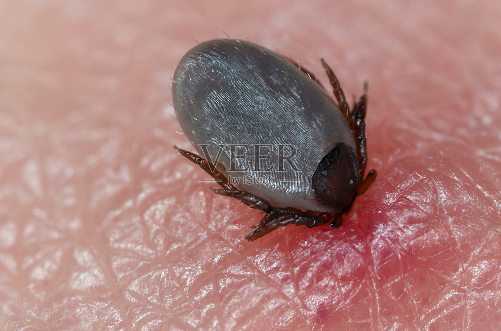 吸附在人类皮肤上的蜱虫。脸红和发红。蛛形纲动物的身体细节、毛发、表面的皱纹清晰可见。照片摄影图片