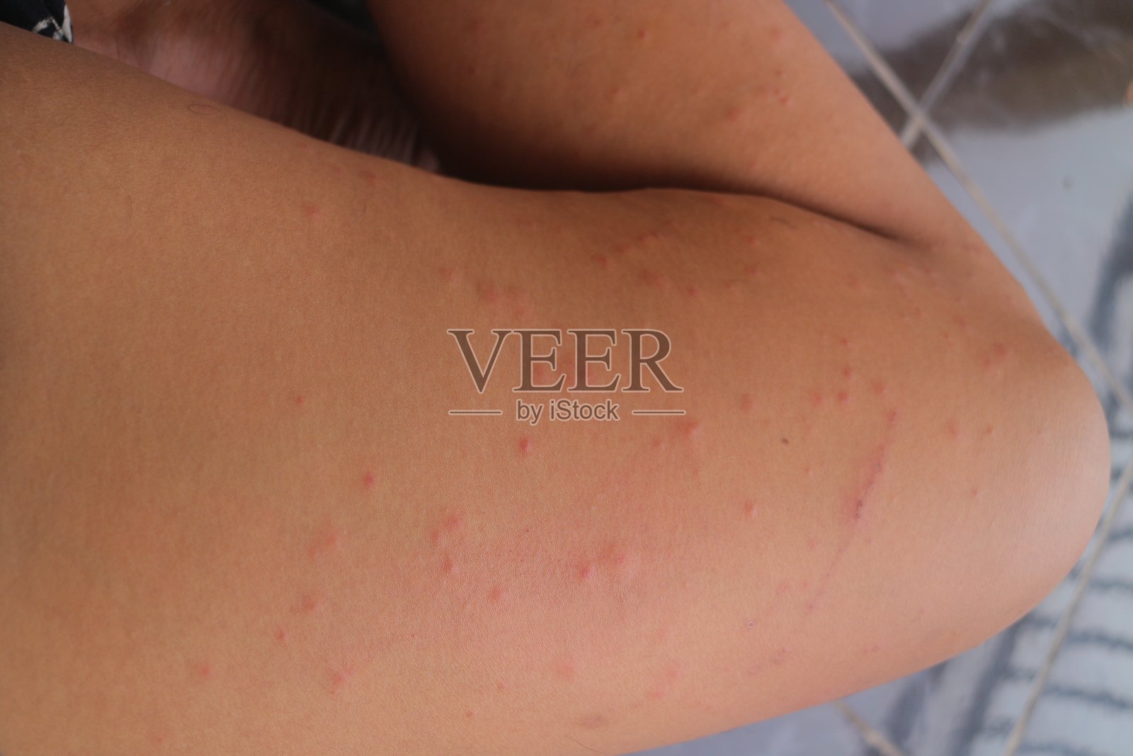 蚊子叮咬引起的皮肤刺激照片摄影图片