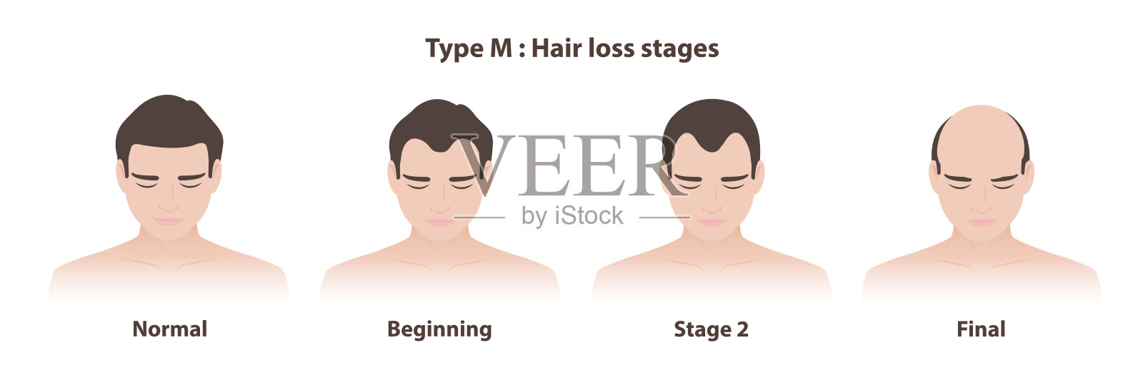男性型脱发的M型脱发阶段矢量插图，背景为白色。插画图片素材