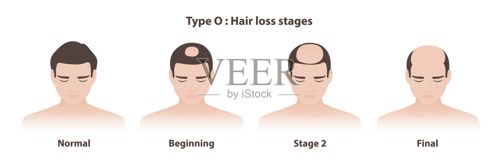男性型脱发的O型脱发阶段矢量插图，背景为白色。插画图片素材
