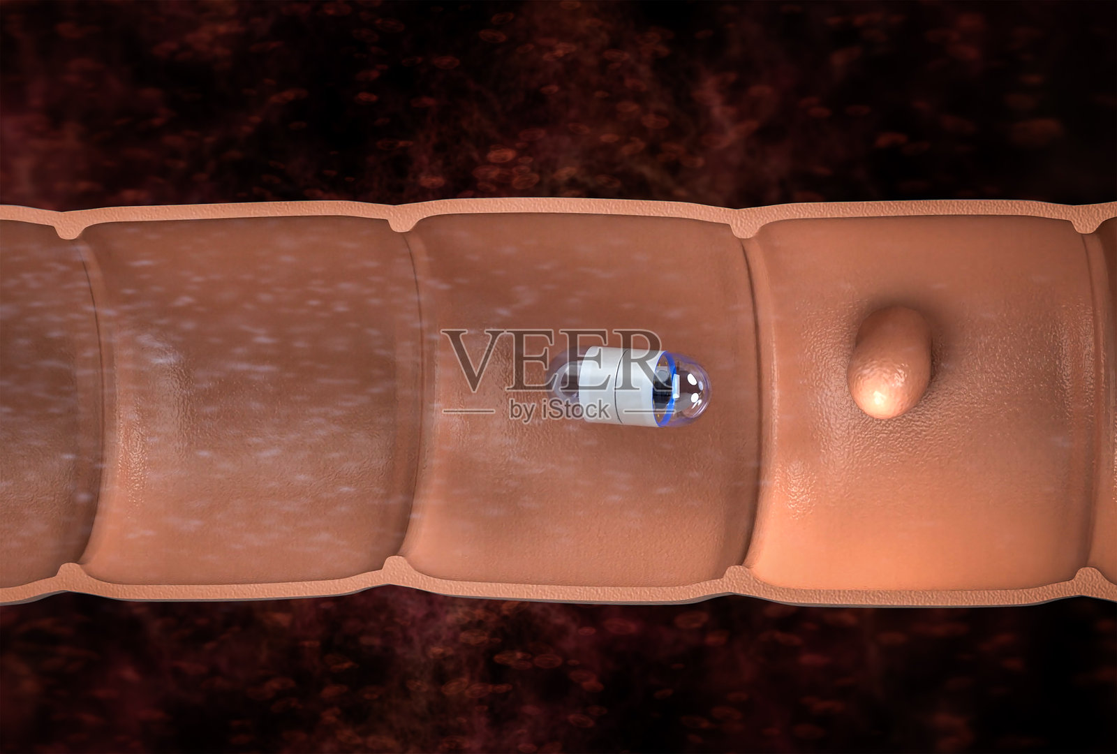 肠道剖面中的胶囊内窥镜检查照片摄影图片