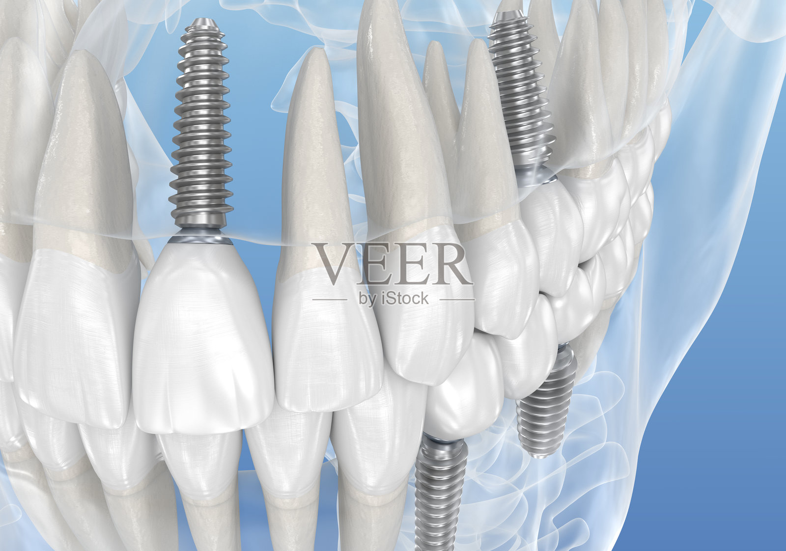 牙齿恢复与牙科植入物，透明视图。医学准确的3D插图照片摄影图片